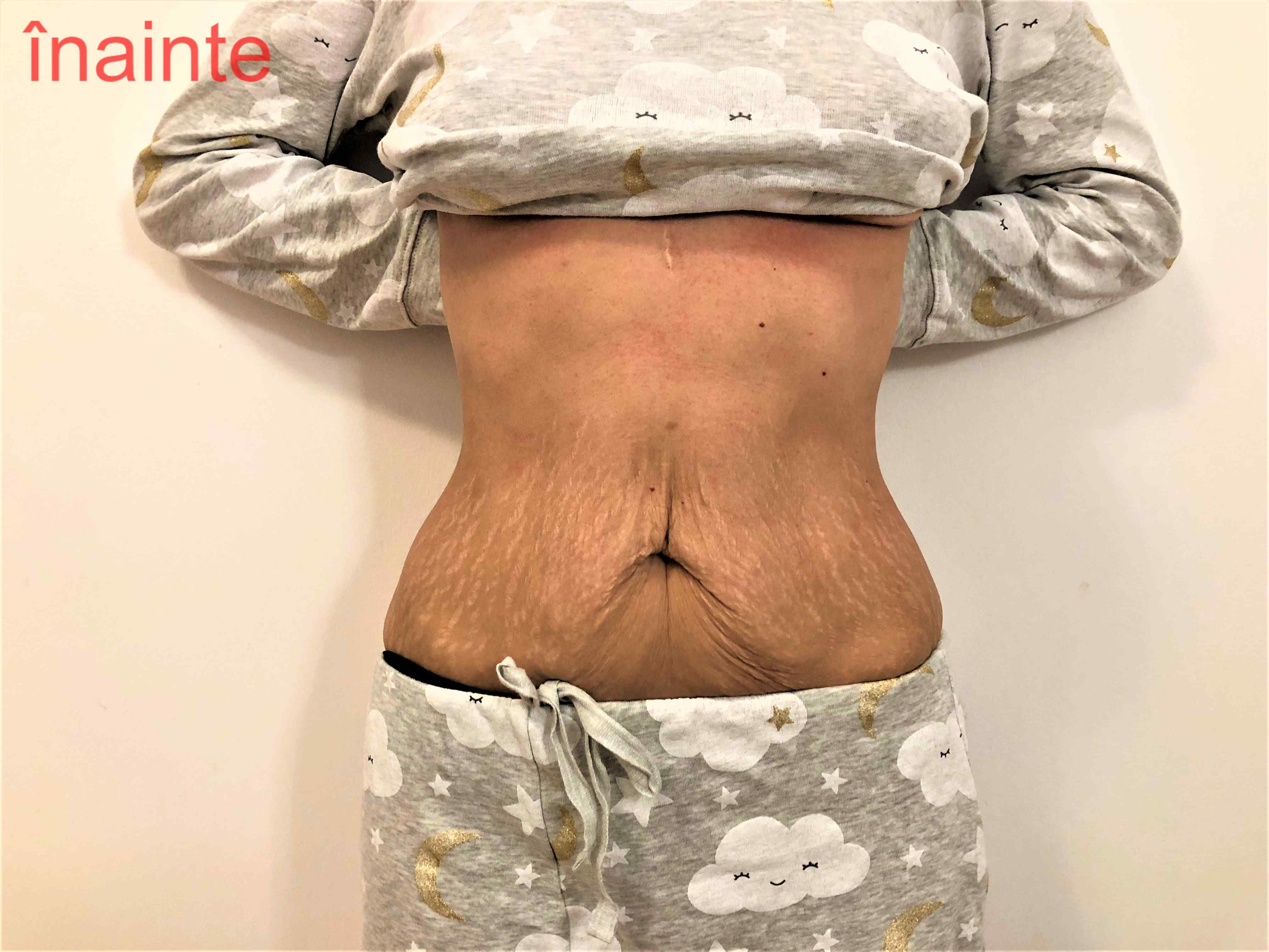 mai bine să piardă în greutate înainte de tummy tuck ceai de slabit teff